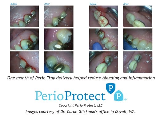 Periodontal (Gum) Disease Treatment