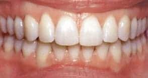 Dental before & after photos - Corbet Locke DDS - Woodway, TX