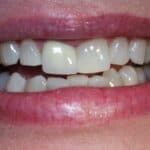 Dental before & after photos - Corbet Locke DDS - Woodway, TX