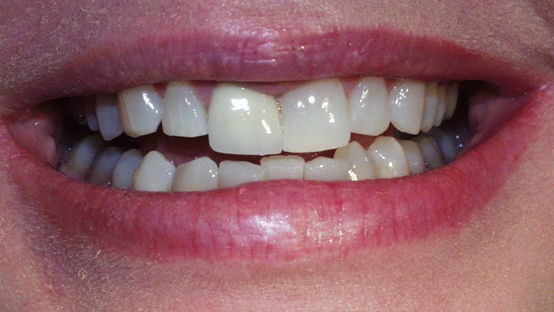 Dental before & after photos - Corbet Locke DDS - Woodway, TX