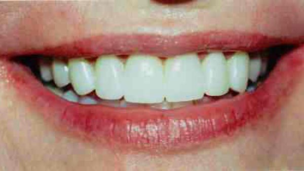 Dental before & after photos - Corbet Locke DDS - Woodway, TX