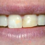 Dental before & after photos - Corbet Locke DDS - Woodway, TX