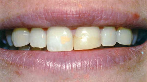 Dental before & after photos - Corbet Locke DDS - Woodway, TX