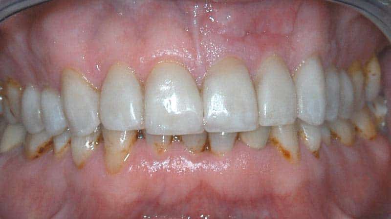 Dental before & after photos - Corbet Locke DDS - Woodway, TX