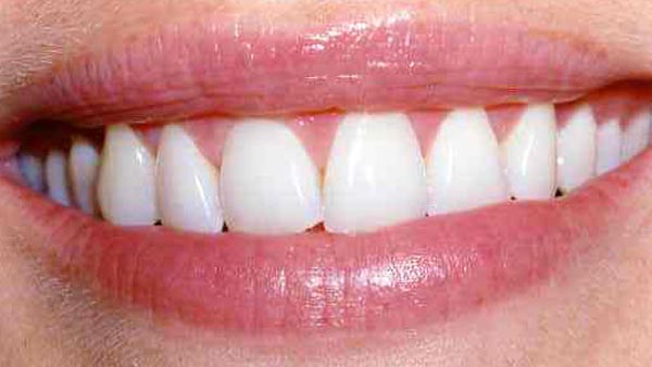 Dental before & after photos - Corbet Locke DDS - Woodway, TX