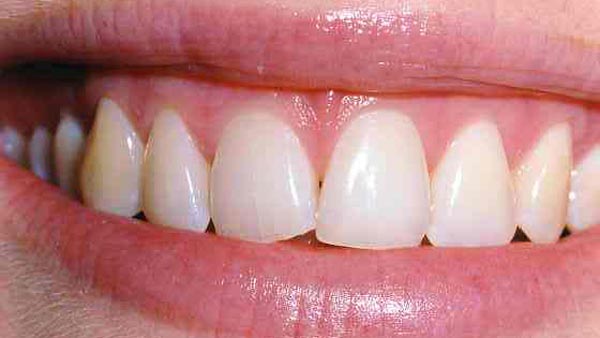 Dental before & after photos - Corbet Locke DDS - Woodway, TX