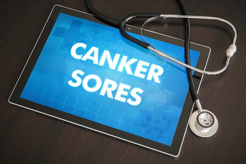 canker sores