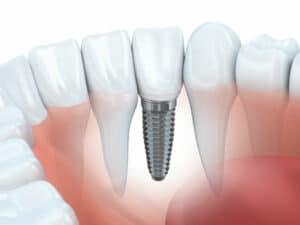 Dental Implants Woodway, TX